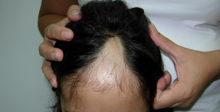 alopecia4