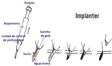 implanter - herramientas de trasplante capilar