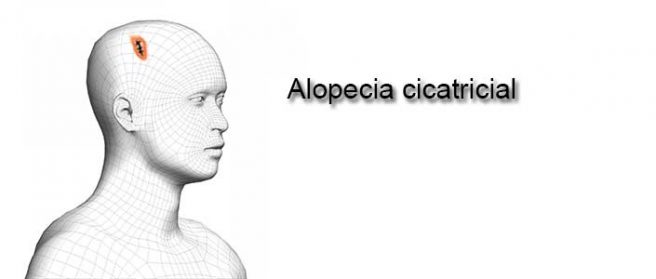 Alopecia cicatricial
